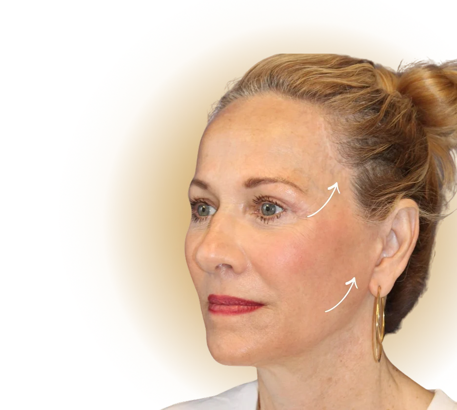 Rinoplastica Tecniche